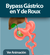 By Pass Gástrico en Y de Roux